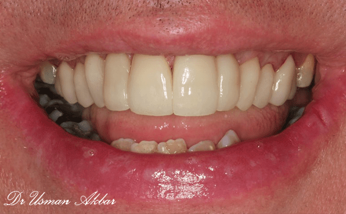 After - Snape Hill Dental Studio & Implant Centre