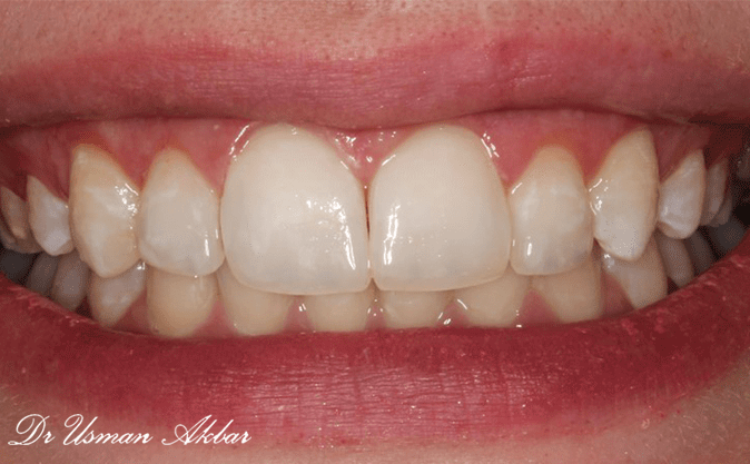 After - Snape Hill Dental Studio & Implant Centre